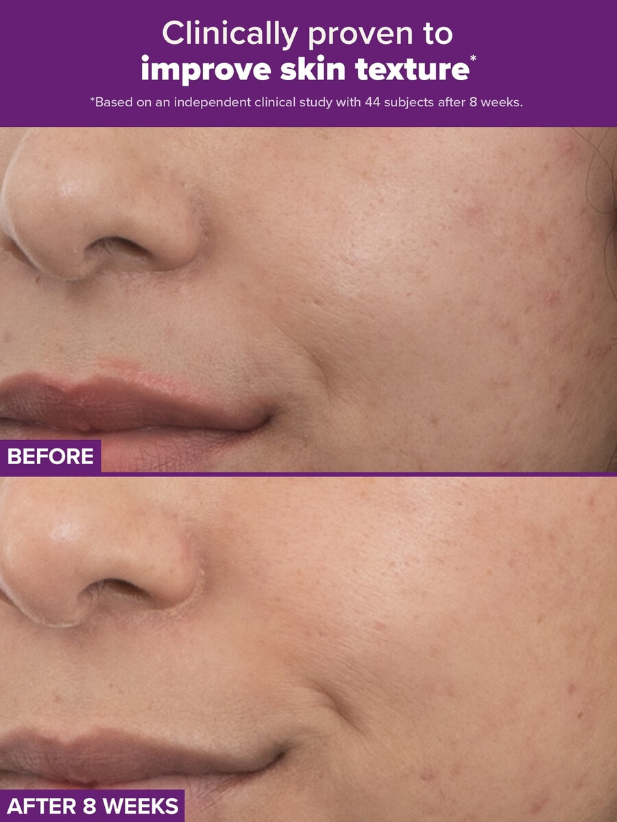clinical pro retinaldehid dvostruki retinoidni tretman