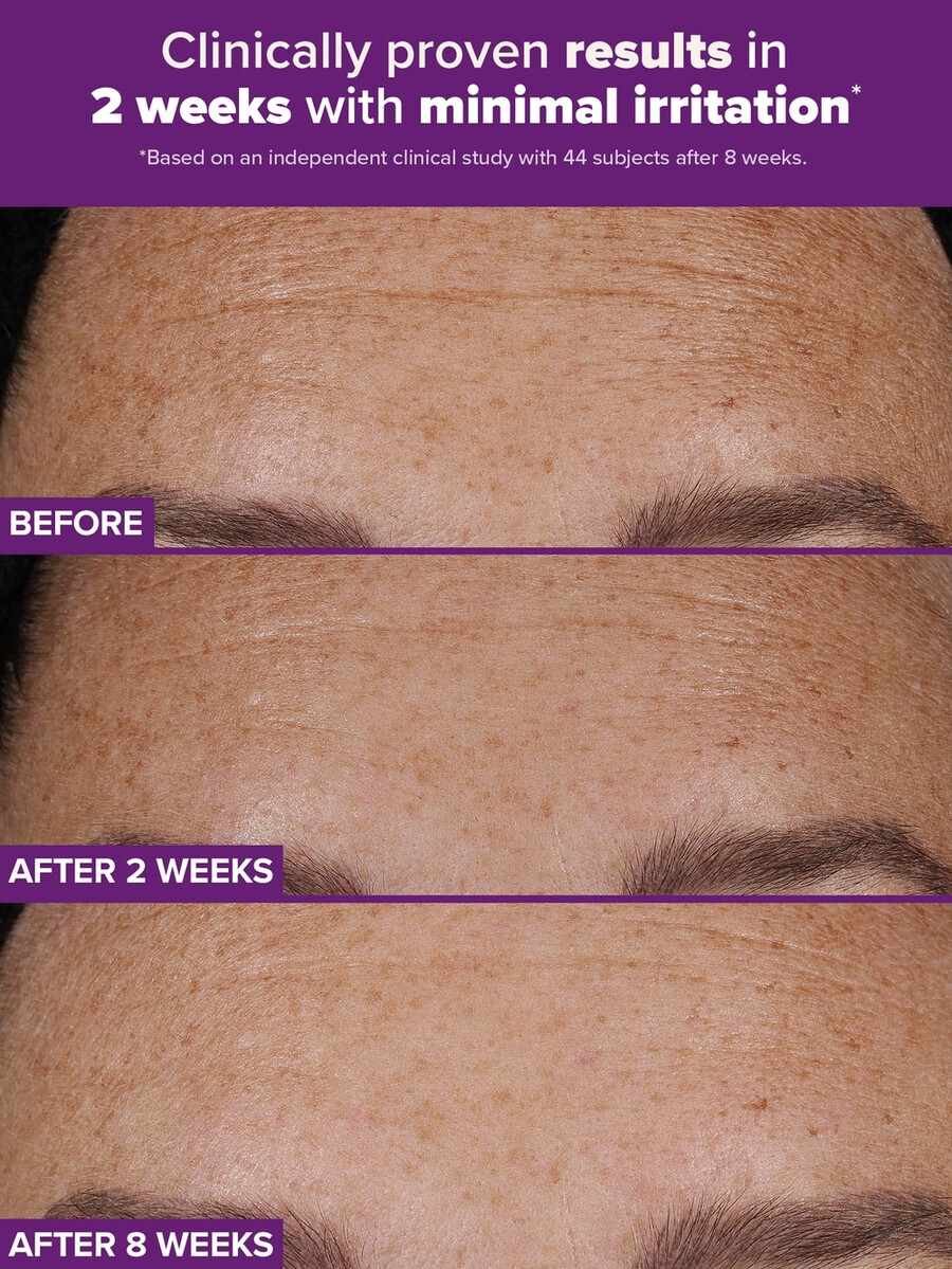 clinical pro retinaldehid dvostruki retinoidni tretman